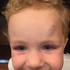 2016-06-10 Chilkoot's new head injury 2